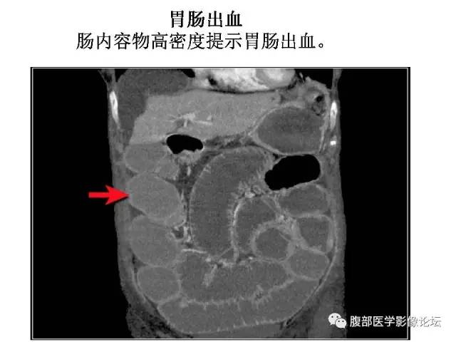 【PPT】肠道壁增厚CT表现