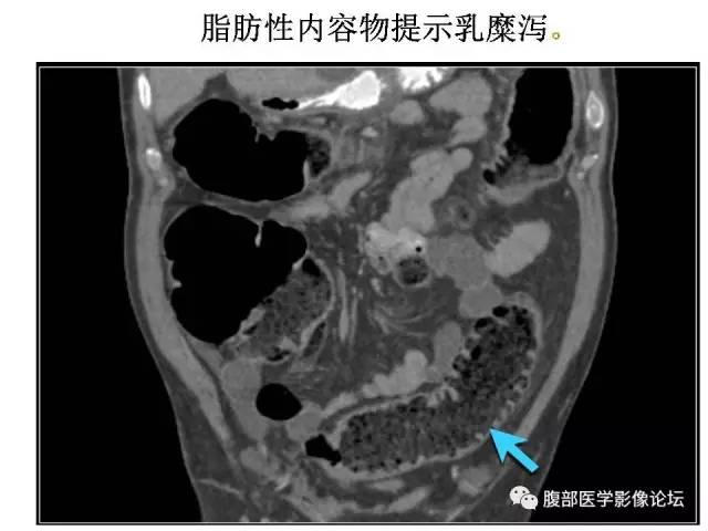 【PPT】肠道壁增厚CT表现