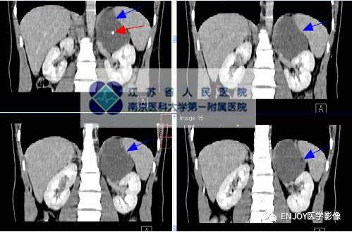 手把手教你会读片：肾上腺节细胞神经瘤