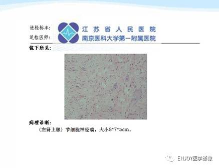 手把手教你会读片：肾上腺节细胞神经瘤