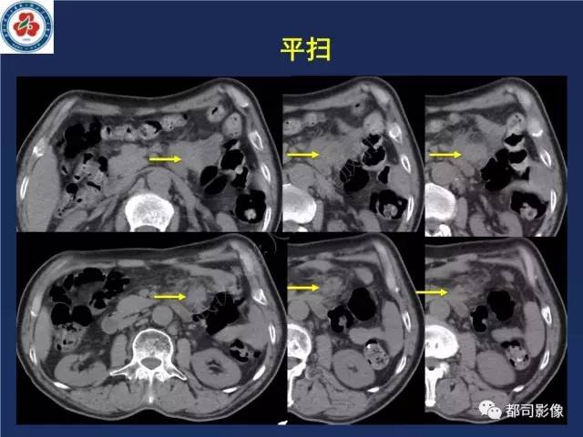 【PPT】十二指肠异位胰腺影像诊断