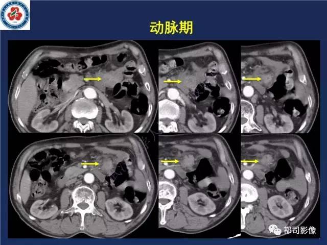 【PPT】十二指肠异位胰腺影像诊断