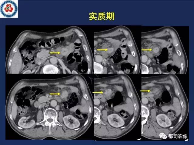 【PPT】十二指肠异位胰腺影像诊断