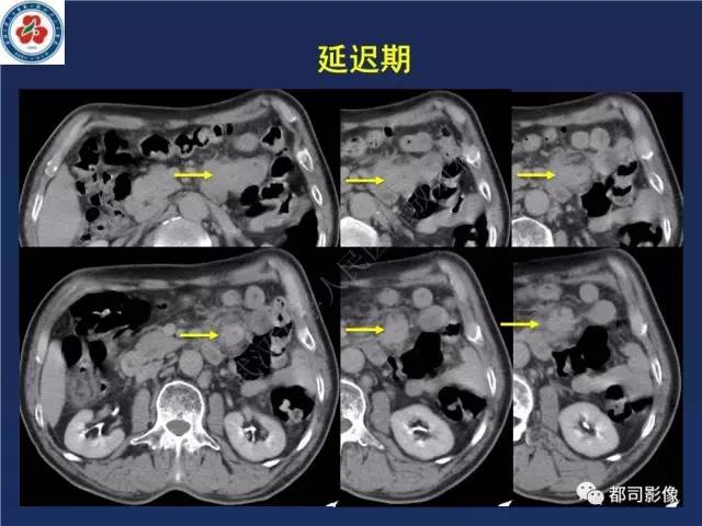 【PPT】十二指肠异位胰腺影像诊断