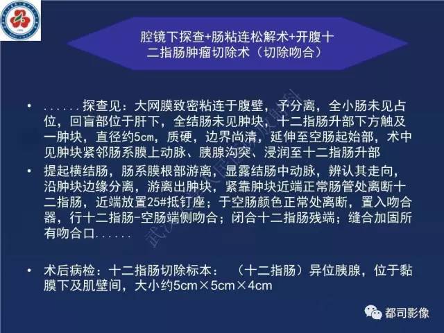 【PPT】十二指肠异位胰腺影像诊断