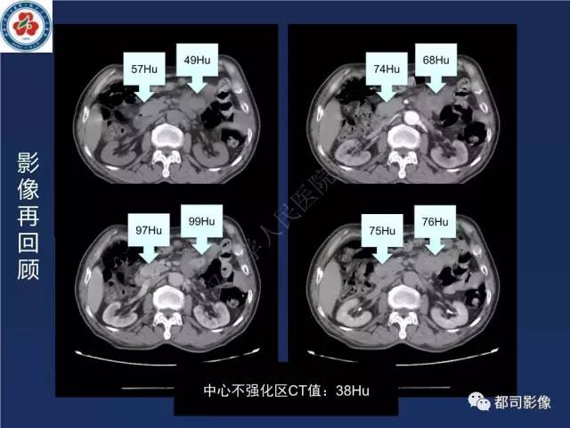 【PPT】十二指肠异位胰腺影像诊断