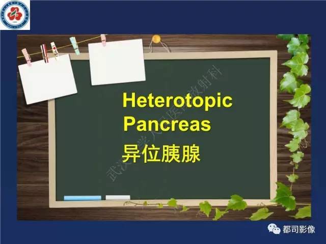 【PPT】十二指肠异位胰腺影像诊断