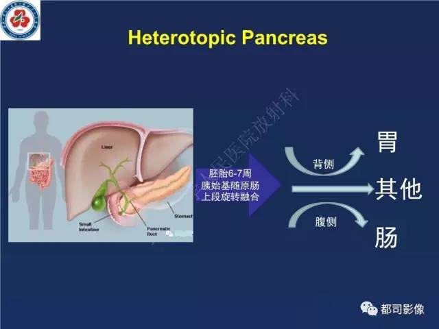【PPT】十二指肠异位胰腺影像诊断