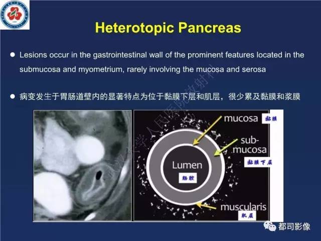【PPT】十二指肠异位胰腺影像诊断