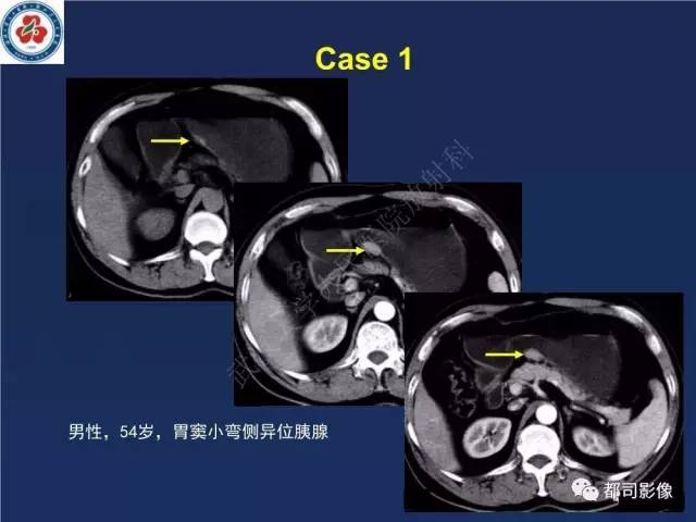 【PPT】十二指肠异位胰腺影像诊断