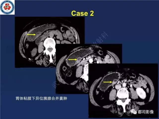 【PPT】十二指肠异位胰腺影像诊断