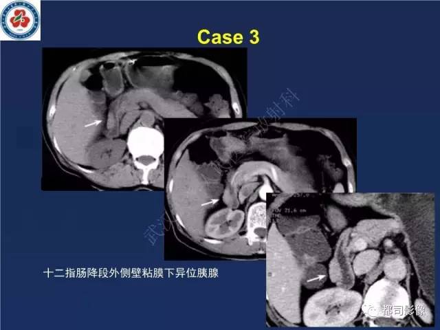 【PPT】十二指肠异位胰腺影像诊断