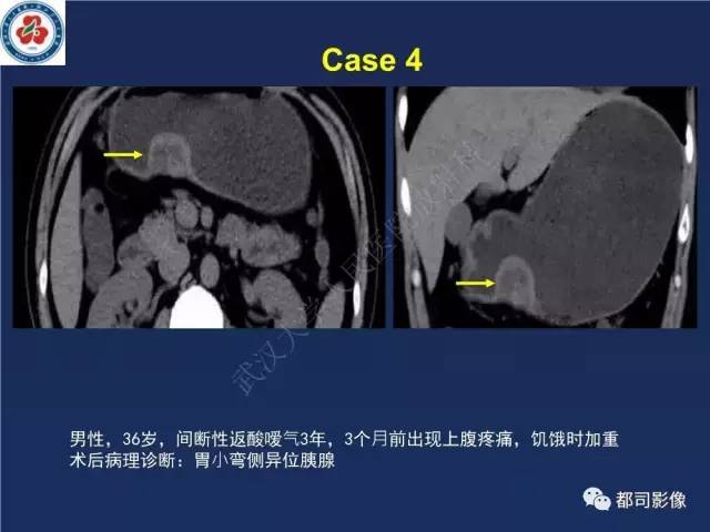 【PPT】十二指肠异位胰腺影像诊断