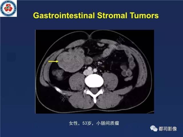 【PPT】十二指肠异位胰腺影像诊断