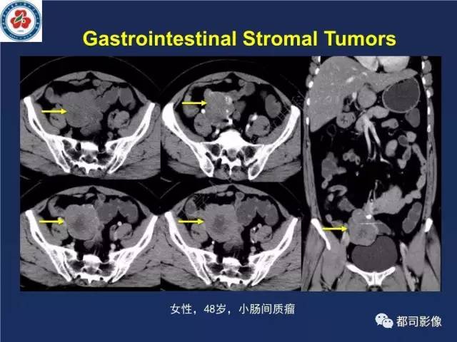 【PPT】十二指肠异位胰腺影像诊断