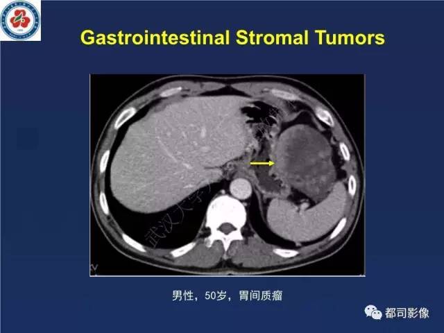 【PPT】十二指肠异位胰腺影像诊断