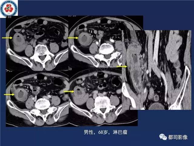 【PPT】十二指肠异位胰腺影像诊断