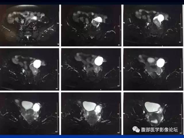 【病例】左输卵管浆液性腺癌1例MR 【病例】左输卵管浆液性腺癌1例MR