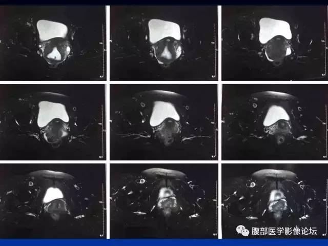 【病例】左输卵管浆液性腺癌1例MR 【病例】左输卵管浆液性腺癌1例MR