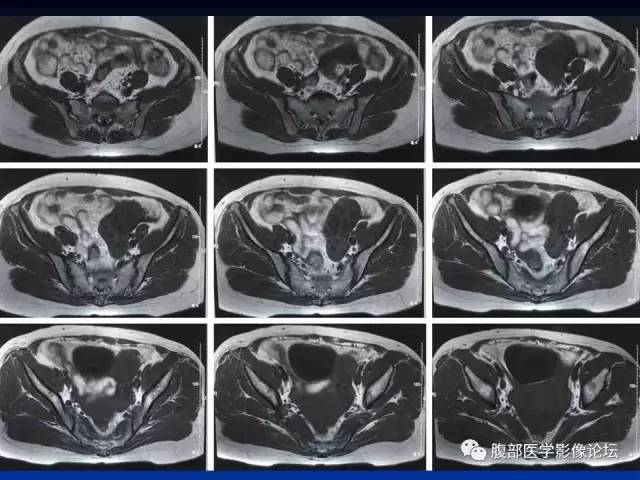 【病例】左输卵管浆液性腺癌1例MR 【病例】左输卵管浆液性腺癌1例MR