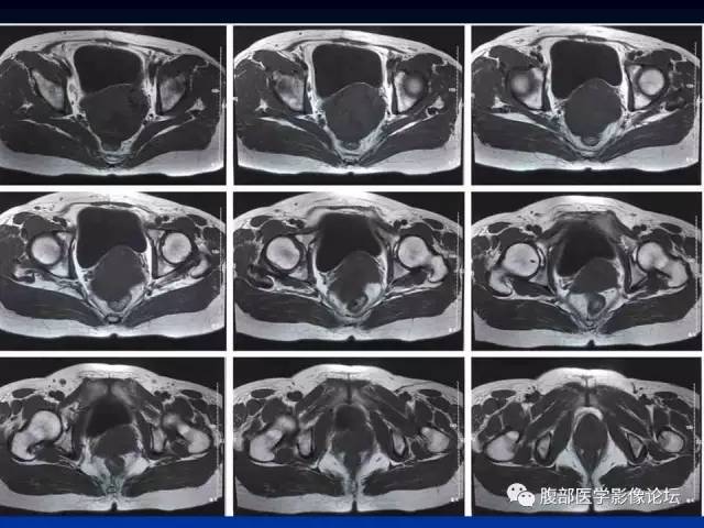 【病例】左输卵管浆液性腺癌1例MR 【病例】左输卵管浆液性腺癌1例MR
