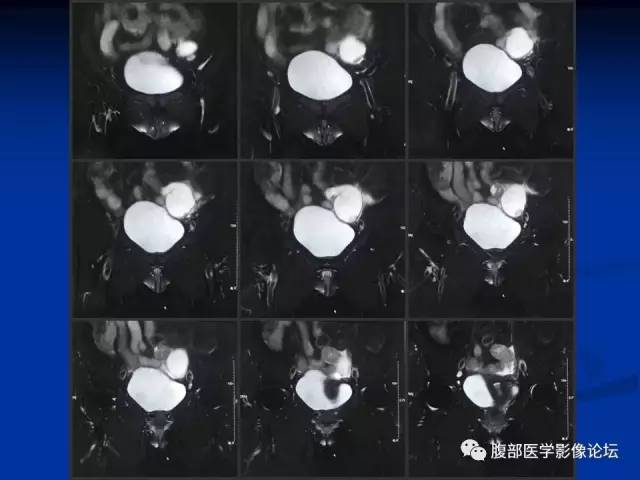 【病例】左输卵管浆液性腺癌1例MR 【病例】左输卵管浆液性腺癌1例MR