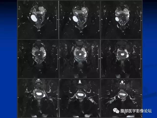 【病例】左输卵管浆液性腺癌1例MR 【病例】左输卵管浆液性腺癌1例MR