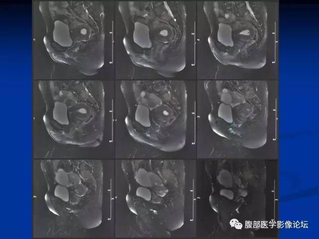【病例】左输卵管浆液性腺癌1例MR 【病例】左输卵管浆液性腺癌1例MR