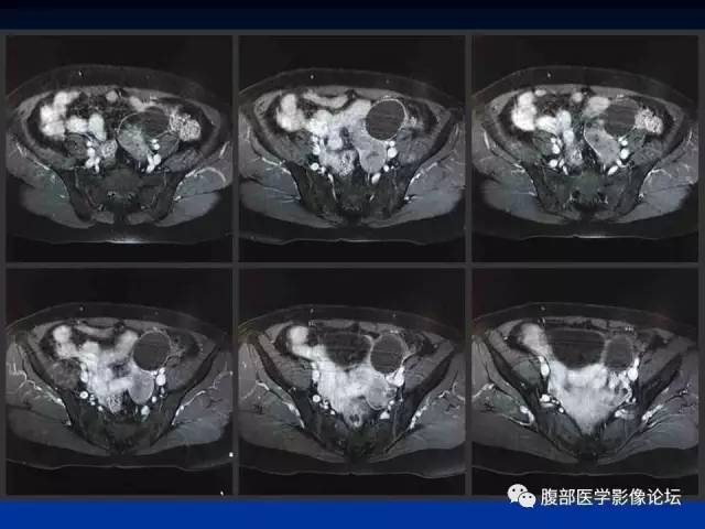 【病例】左输卵管浆液性腺癌1例MR 【病例】左输卵管浆液性腺癌1例MR