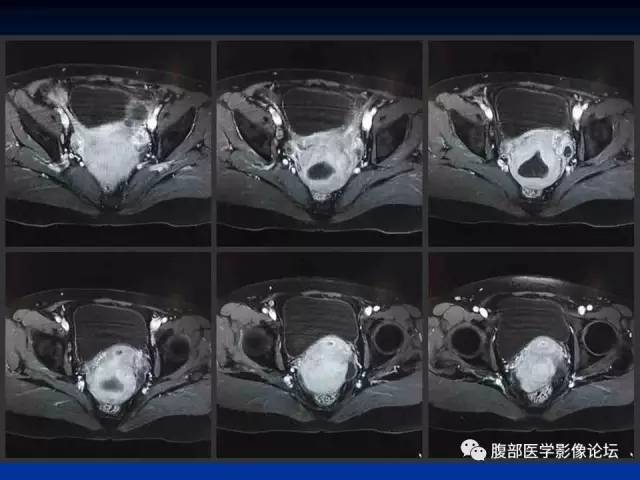 【病例】左输卵管浆液性腺癌1例MR 【病例】左输卵管浆液性腺癌1例MR