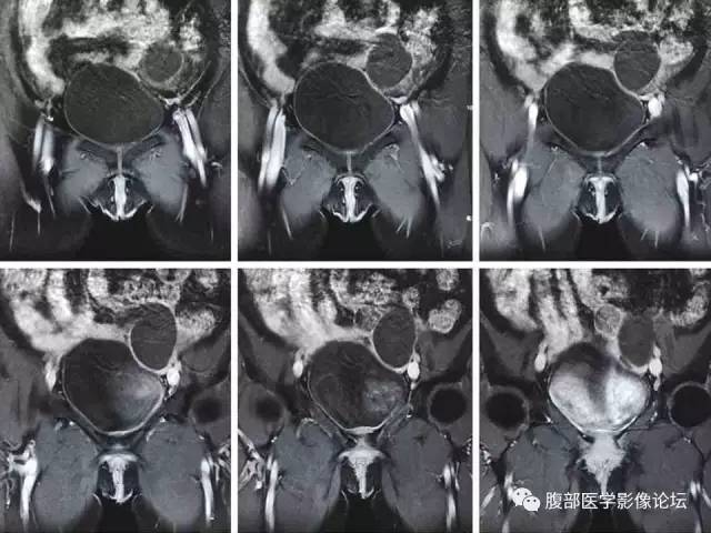【病例】左输卵管浆液性腺癌1例MR 【病例】左输卵管浆液性腺癌1例MR