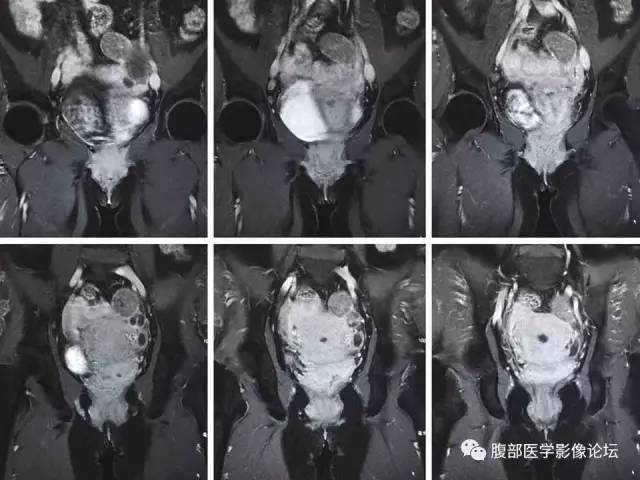 【病例】左输卵管浆液性腺癌1例MR 【病例】左输卵管浆液性腺癌1例MR