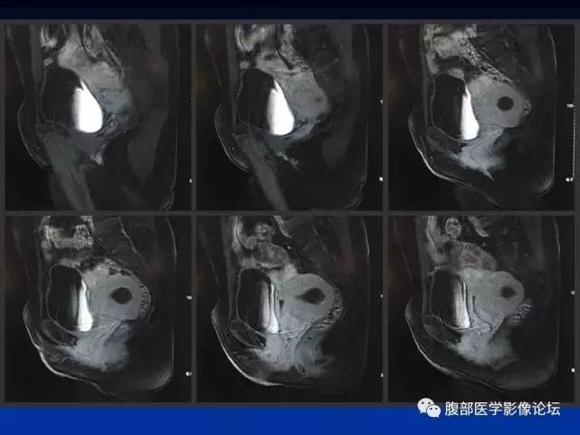 【病例】左输卵管浆液性腺癌1例MR 【病例】左输卵管浆液性腺癌1例MR