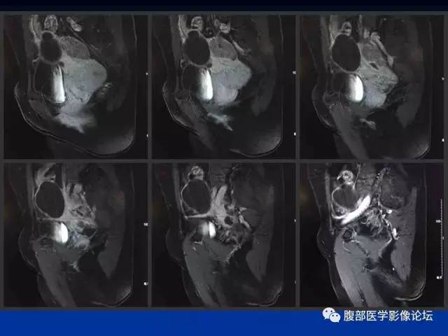 【病例】左输卵管浆液性腺癌1例MR 【病例】左输卵管浆液性腺癌1例MR