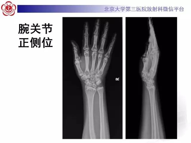 【病例】骨斑点症1例X线MR影像表现