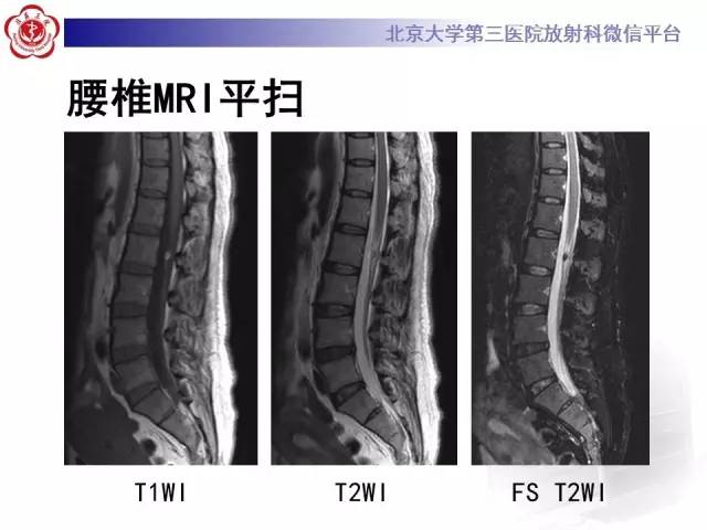 【病例】骨斑点症1例X线MR影像表现
