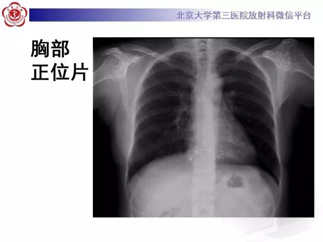 【病例】骨斑点症1例X线MR影像表现