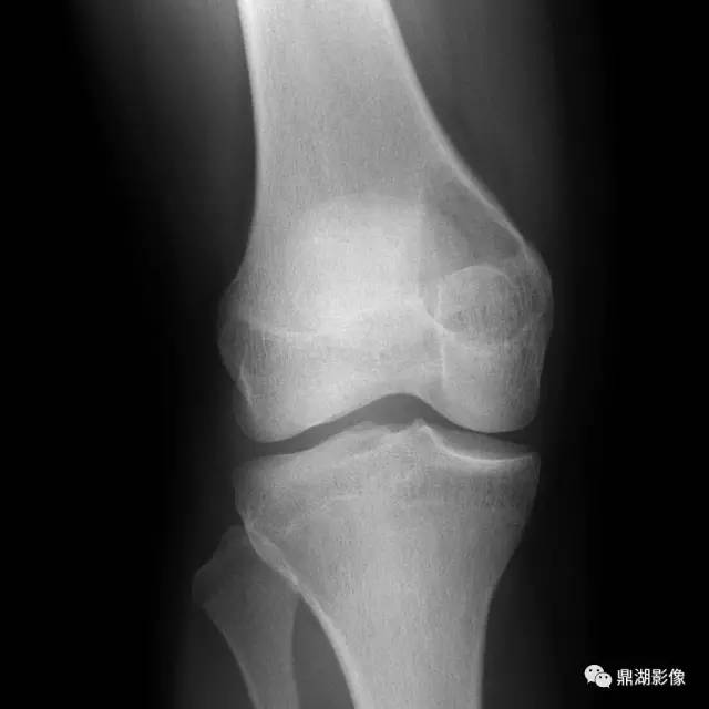 六种长管状骨干骺端常见良性疾病