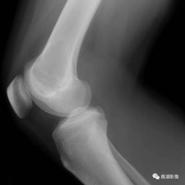 六种长管状骨干骺端常见良性疾病