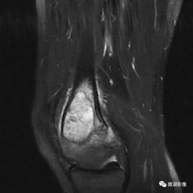 六种长管状骨干骺端常见良性疾病