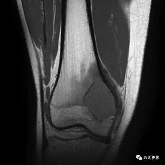 六种长管状骨干骺端常见良性疾病