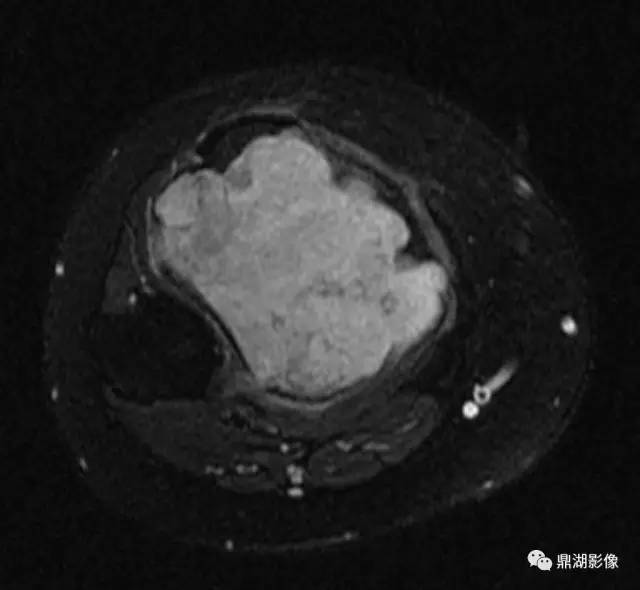 六种长管状骨干骺端常见良性疾病