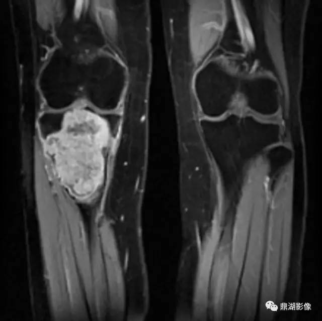 六种长管状骨干骺端常见良性疾病