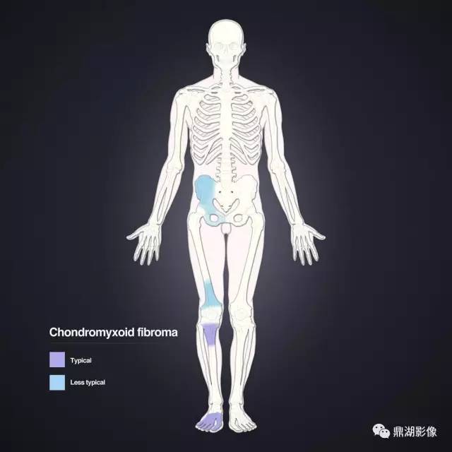 六种长管状骨干骺端常见良性疾病
