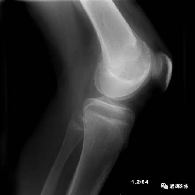 六种长管状骨干骺端常见良性疾病