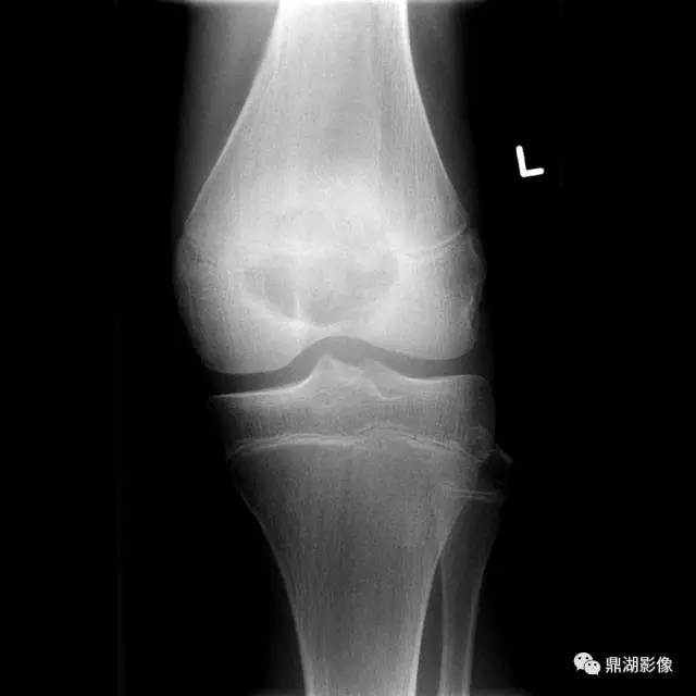 六种长管状骨干骺端常见良性疾病