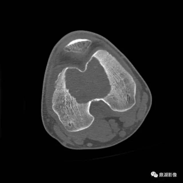 六种长管状骨干骺端常见良性疾病