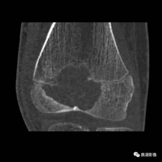 六种长管状骨干骺端常见良性疾病