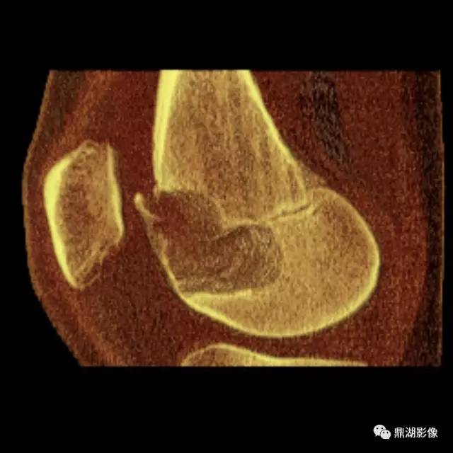 六种长管状骨干骺端常见良性疾病