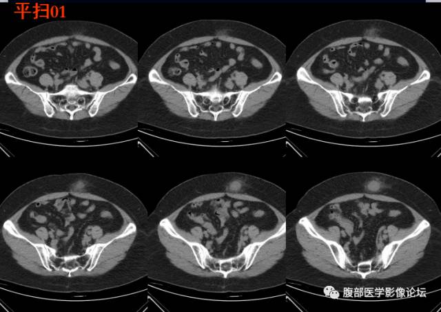 【病例】腹壁脂膜炎一例CT 【病例】腹壁脂膜炎一例CT